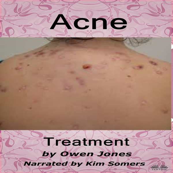 Acne Treatment scrisă de Owen Jones și narată de Kim Somers 