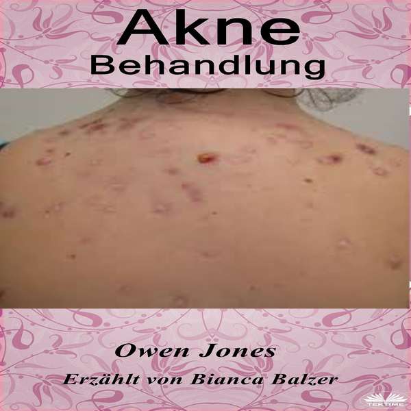 Akne-Behandlung written by Owen Jones and narrated by Bianca Balzer 